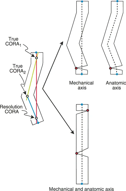 تقويم تشوهات الأطراف السفلية بدقة متناهية: دليلك الشامل لمبادئ بالي المتقدمة ومركز دوران الانحراف (CORA)