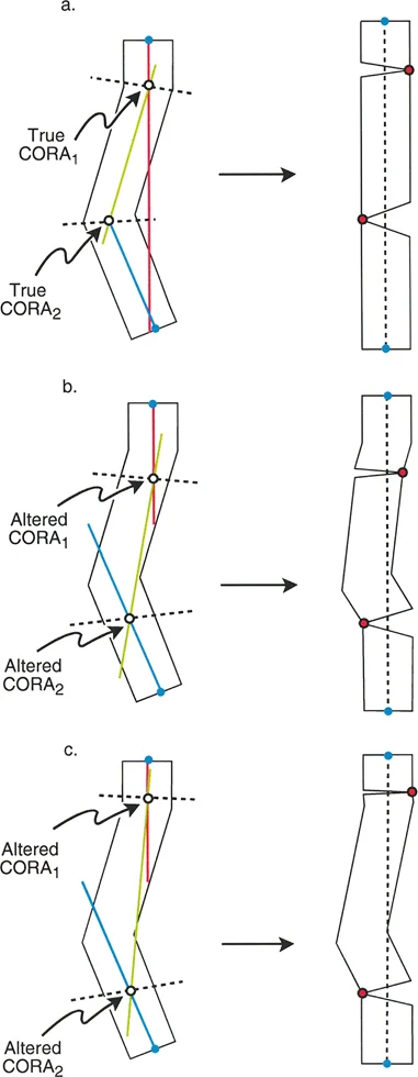 صورة توضيحية لـ تقويم تشوهات الأطراف السفلية بدقة متناهية: دليلك الشامل لمبادئ بالي المتقدمة ومركز دوران الانحراف (CORA)