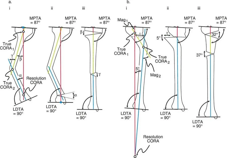 صورة توضيحية لـ تقويم تشوهات الأطراف السفلية بدقة متناهية: دليلك الشامل لمبادئ بالي المتقدمة ومركز دوران الانحراف (CORA)