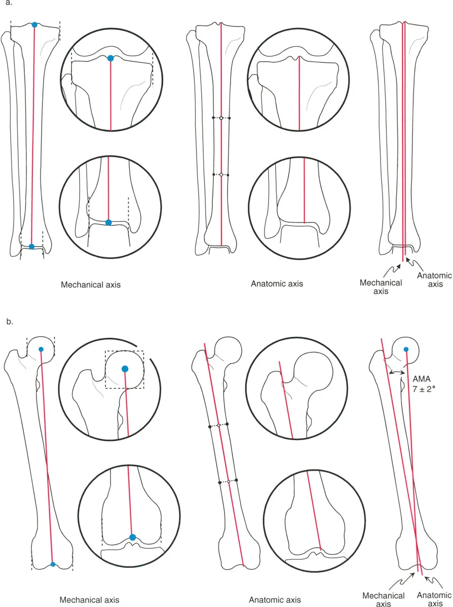 عرض مفصل لزاوية المحور التشريحي-الميكانيكي (AMA) لعظم الفخذ، موضحًا تباعد 7° ± 2° بين المحور الميكانيكي (الذي يربط مراكز المفاصل) والمحور التشريحي (خط منتصف جسم العظم).