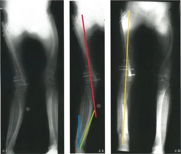 صورة توضيحية لـ تصحيح انحرافات الساقين المعقدة: دليل شامل لتقويم تشوهات العظام متعددة المستويات في صنعاء