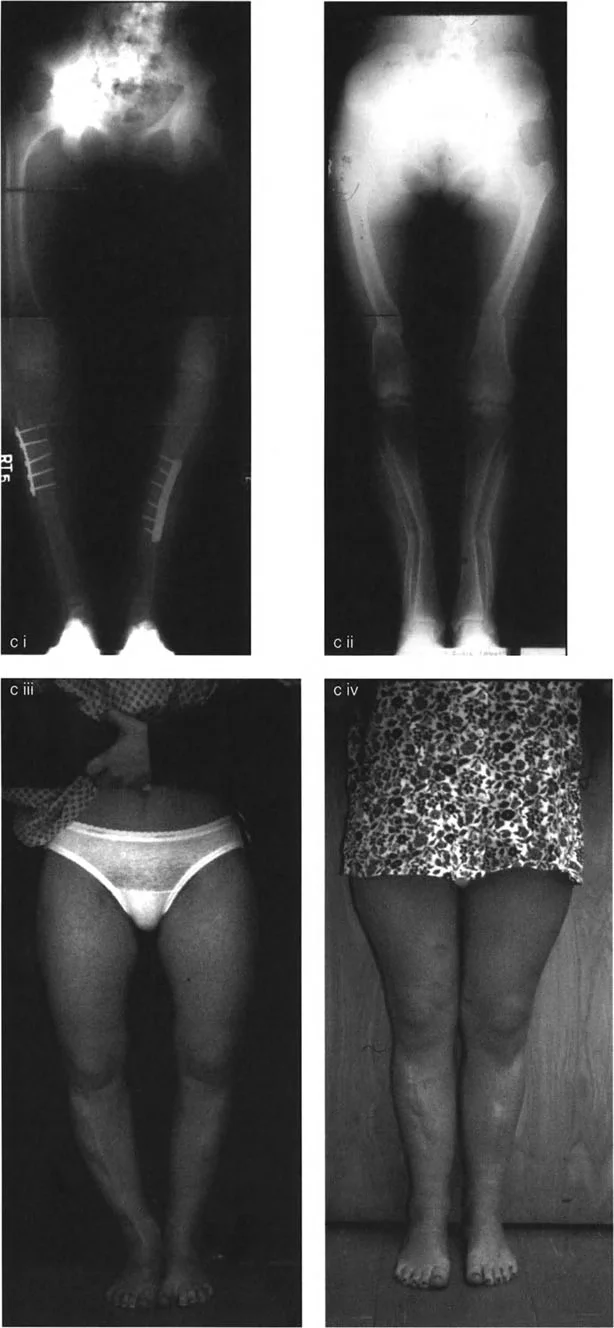جراحة تقويم انحرافات العظام في المستوى الأمامي: حلول متقدمة لتشوهات الأطراف السفلية المعقدة