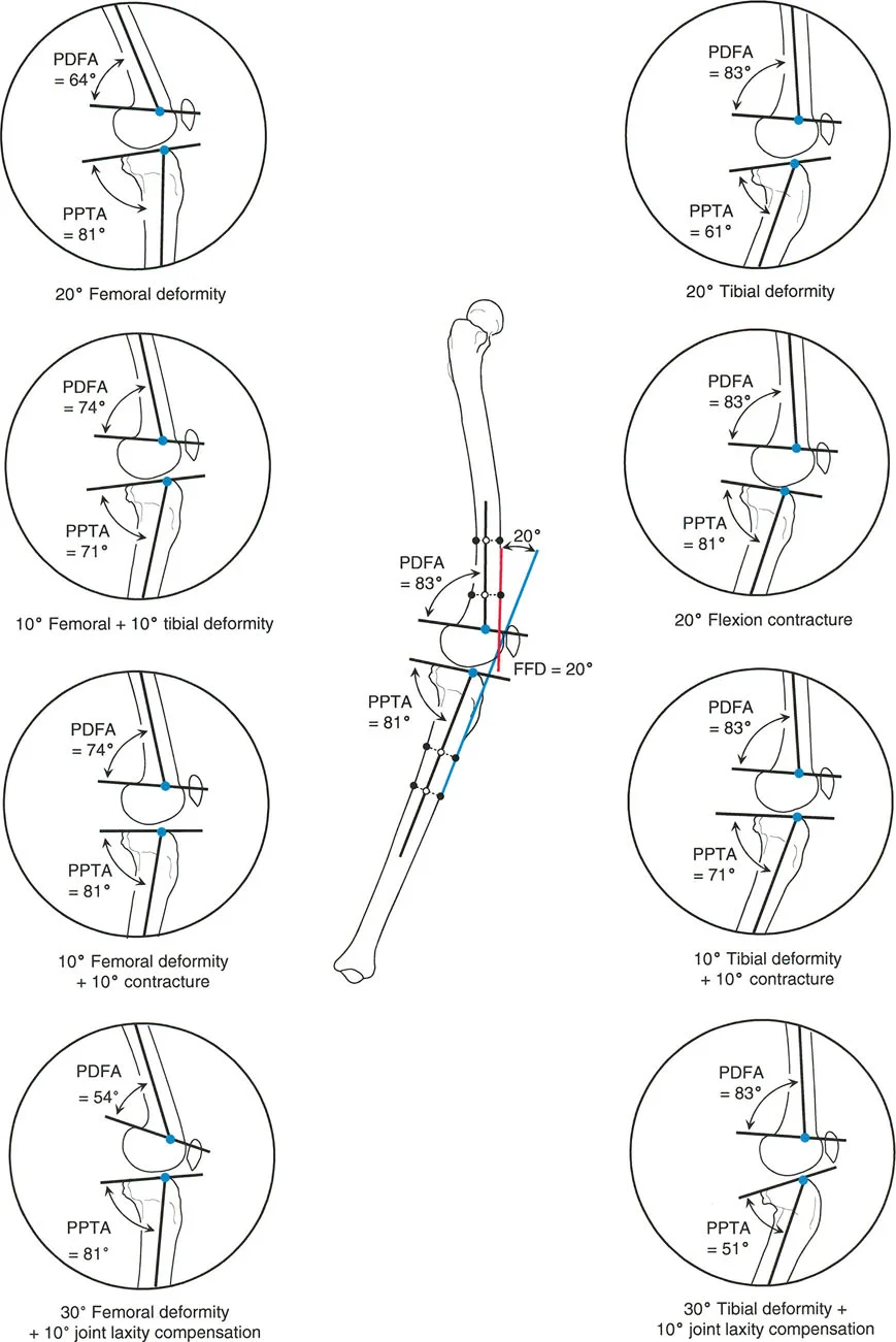 Mastering Sagittal Plane Deformities: The Ultimate Orthopedic Guide to Procurvatum, Recurvatum, and Alignment