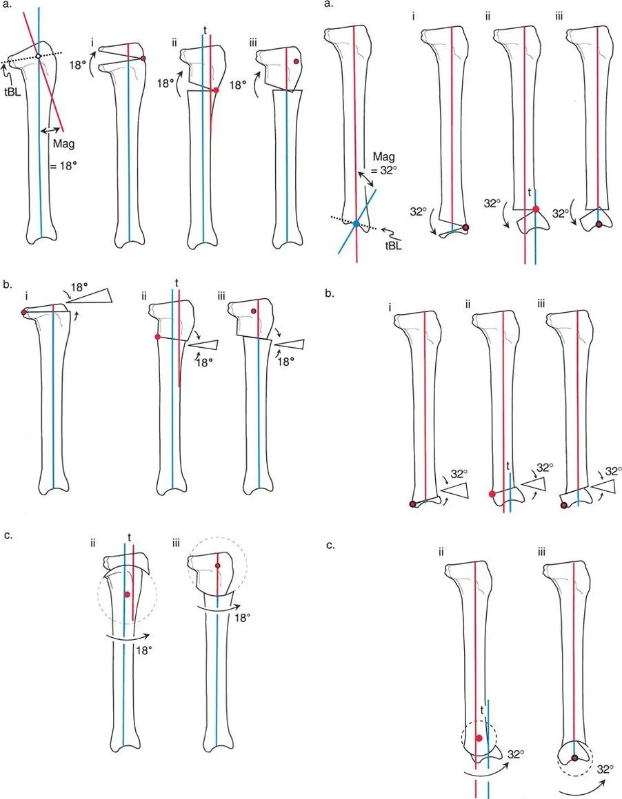 صورة توضيحية لـ تشوهات المستوى السهمي للطرف السفلي: دليلك الشامل لطريقة بالي مع الأستاذ الدكتور محمد هطيف في صنعاء
