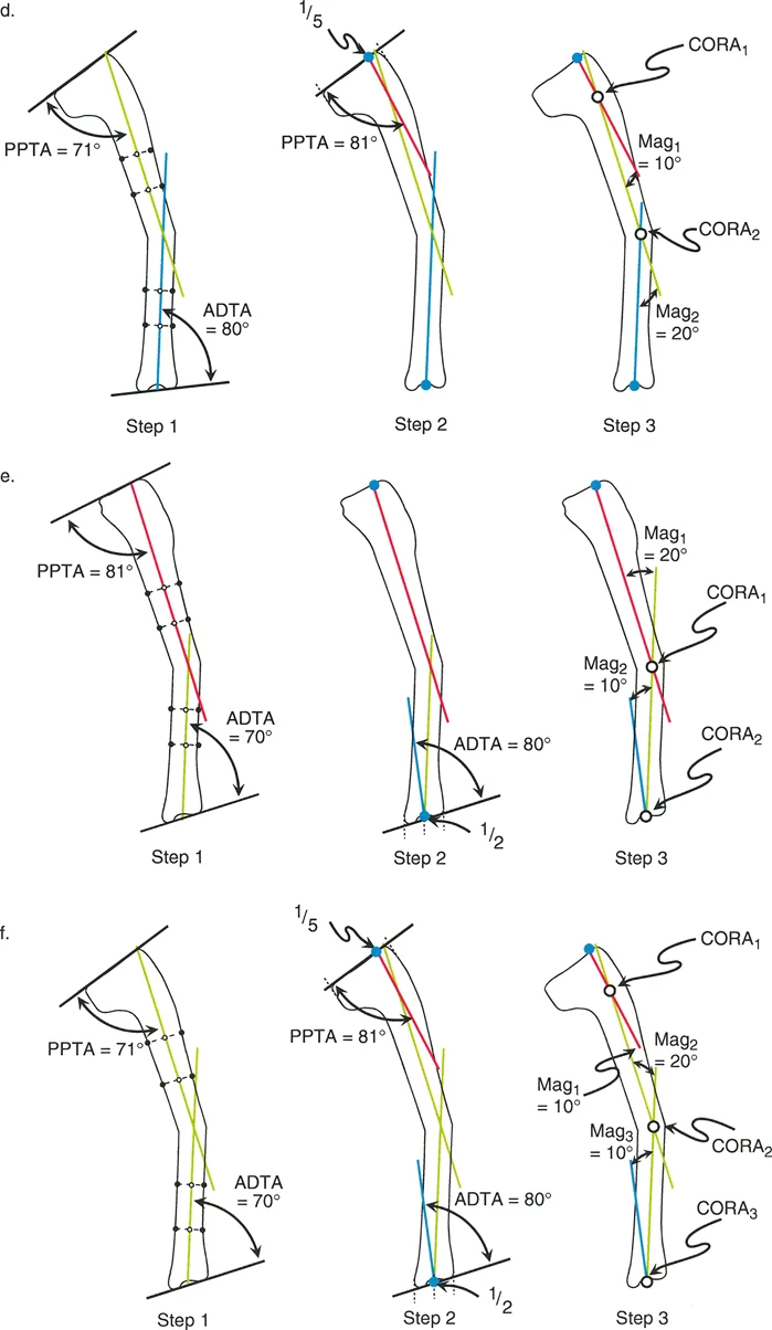 مزيج من تشوهات الساق. (د) مزيج من تشوه منتصف الساق والقريب. (هـ) مزيج من تشوه منتصف الساق والبعيد. (و) مزيج متعدد القمم من تشوهات قريبة ومنتصف الساق وبعيدة.