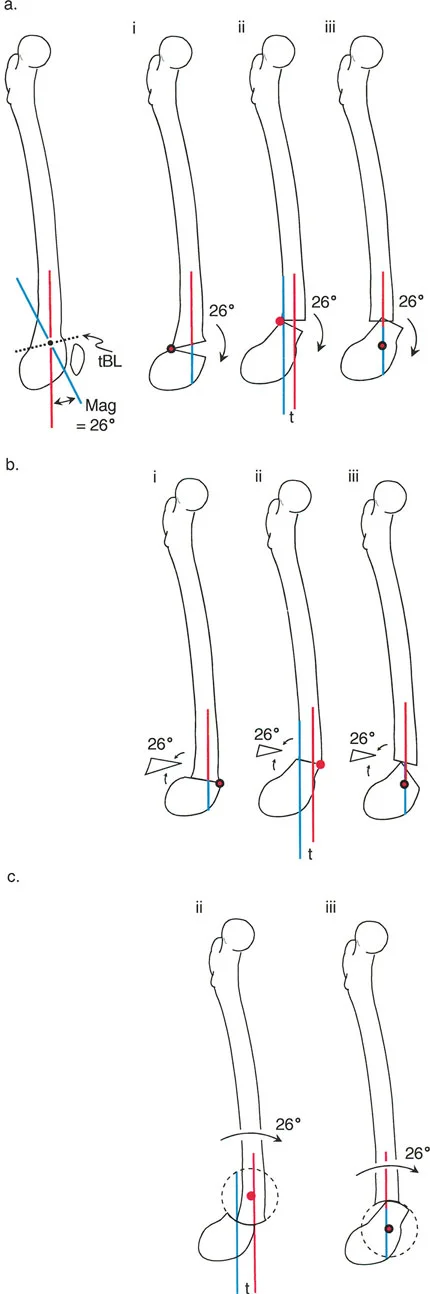 صورة توضيحية لـ تشوهات المستوى السهمي للطرف السفلي: دليلك الشامل لطريقة بالي مع الأستاذ الدكتور محمد هطيف في صنعاء