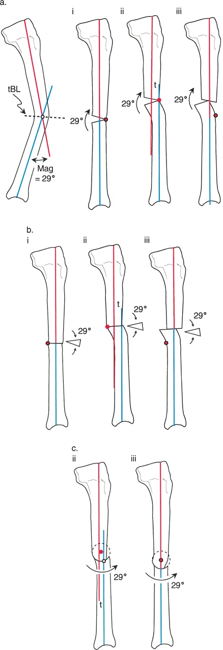 تشوهات المستوى السهمي للطرف السفلي: دليلك الشامل لطريقة بالي مع الأستاذ الدكتور محمد هطيف في صنعاء
