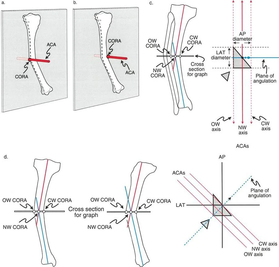 Mastering Oblique Plane Deformities: The Ultimate Paley Orthopedic Guide