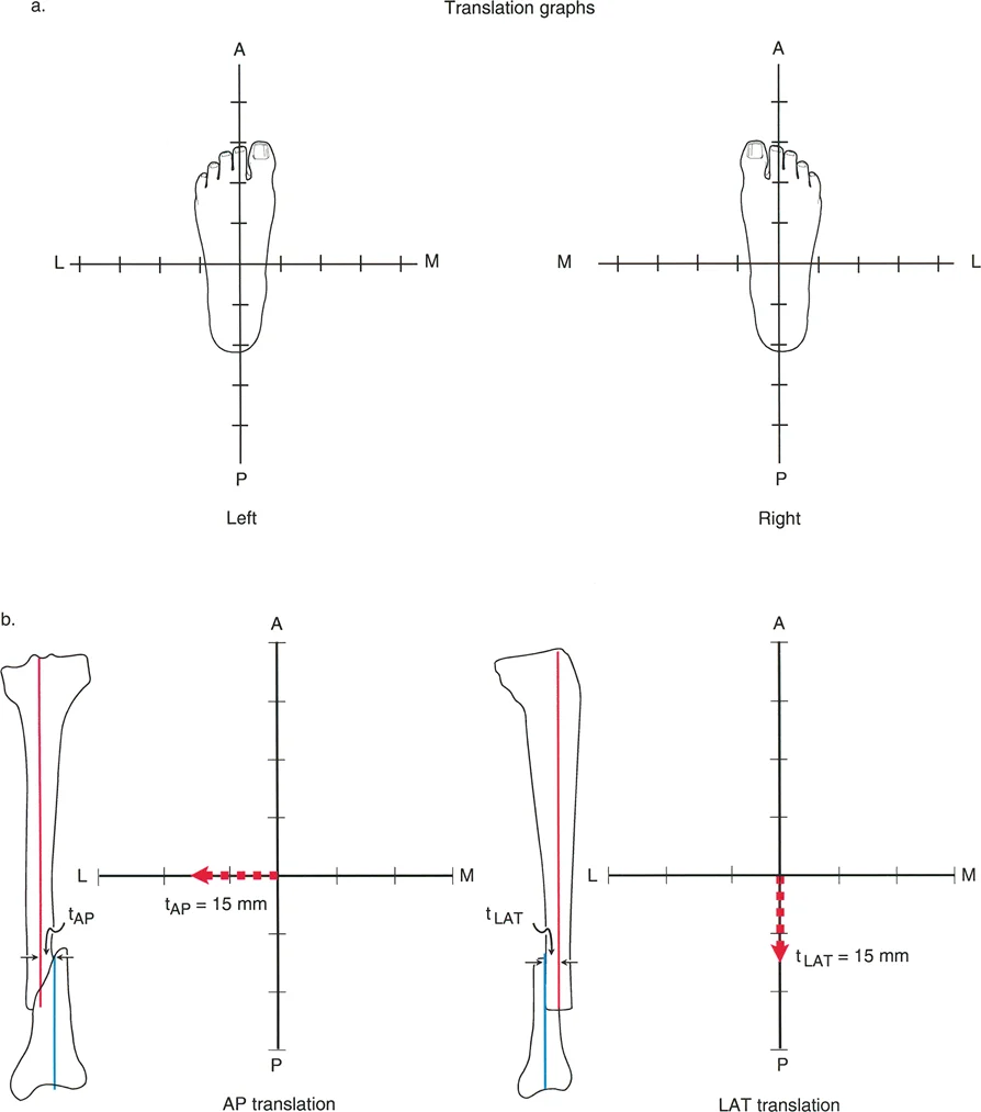 تشوهات الانزياح والانزياح الزاوي في العظام: دليل شامل للمرضى مع الأستاذ الدكتور محمد هطيف