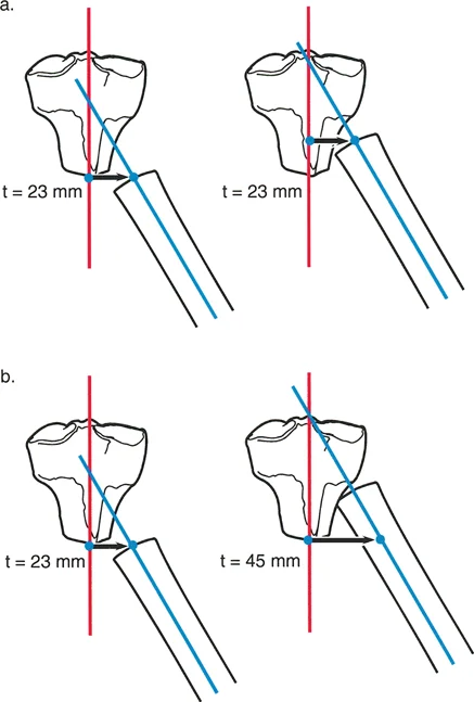 قياس تشوهات الانحراف-الانزياح. يفرض المعيار قياس المسافة العمودية من المحور القريب (الخط الأحمر) إلى المحور البعيد (الخط الأزرق) بالضبط عند مستوى الطرف القريب من الجزء البعيد من العظم (t = 23 ملم في الأمثلة العلوية).