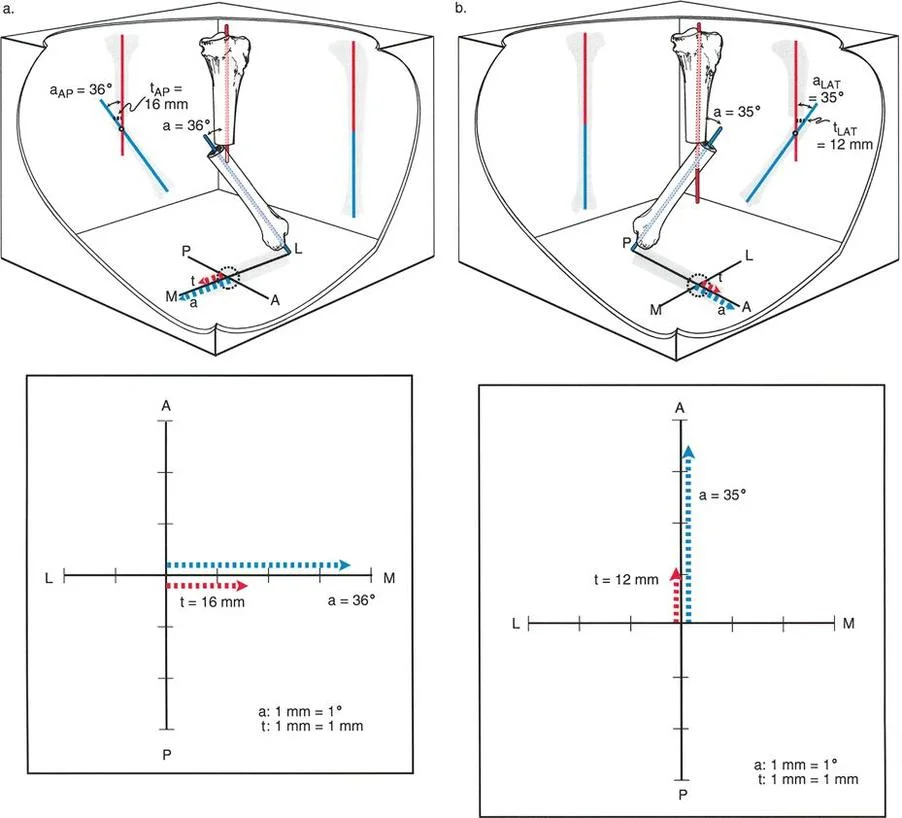 صورة توضيحية لـ تشوهات الانحراف والانزياح العظمي: دليل شامل لفهم وعلاج انحرافات العظام المعقدة مع الأستاذ الدكتور محمد هطيف