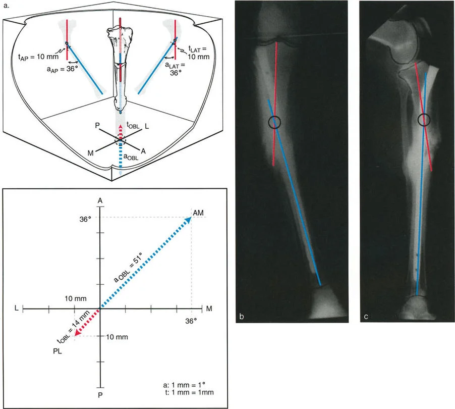 تشوهات الانحراف والترجمة العظمية: دليل المريض الشامل لتصحيح تشوهات العظام المعقدة مع الأستاذ الدكتور محمد هطيف