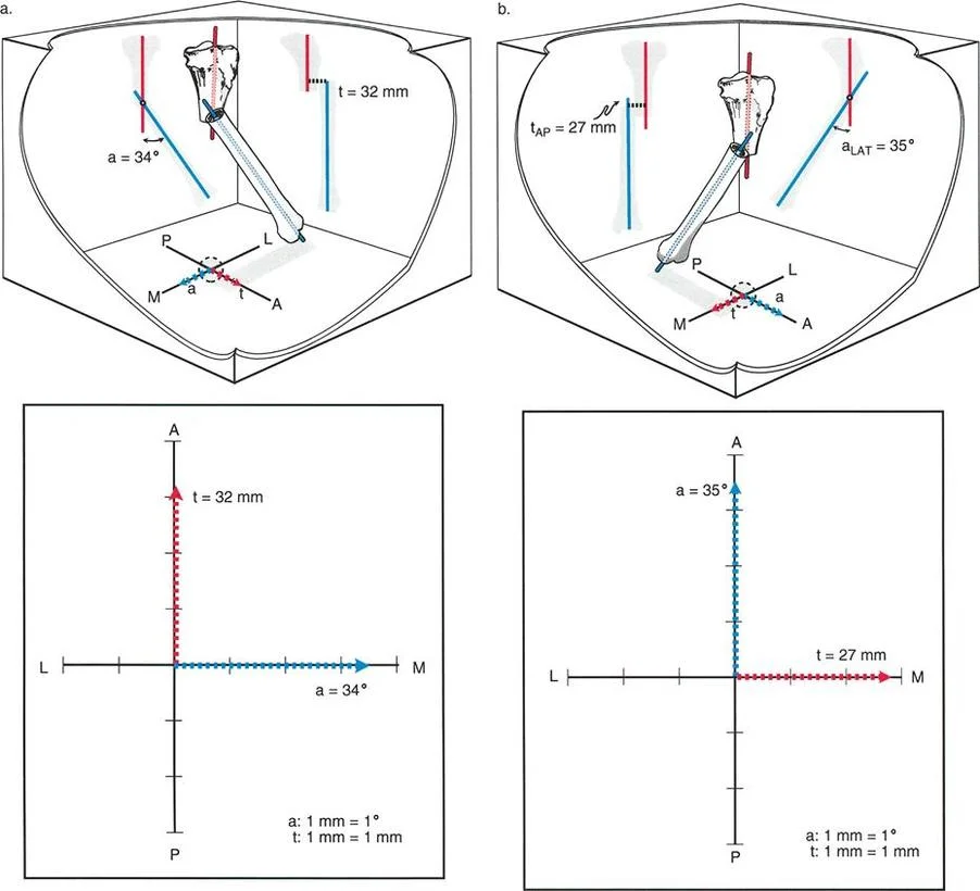 صورة توضيحية لتشوه الانحراف والترجمة في مستويين مختلفين (النوع 2 المتغير 1)، تظهر فيها نماذج ثلاثية الأبعاد للعظم ورسوم بيانية توضح فصل متجهات الانحراف والترجمة بزاوية 90 درجة.
