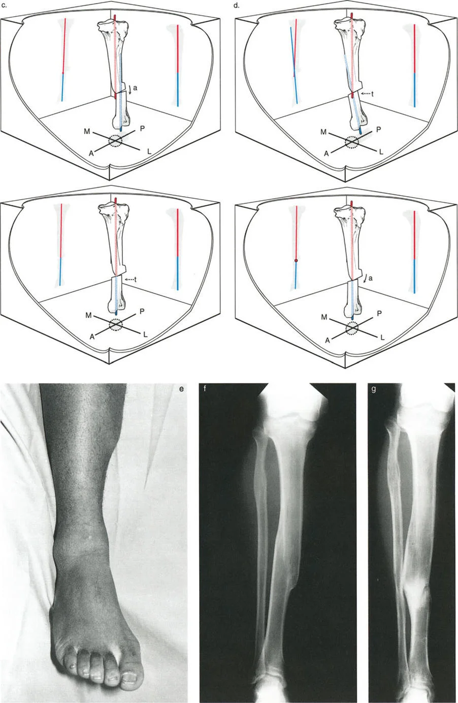 صورة توضيحية لـ تصحيح تشوهات الانحراف والإزاحة العظمية: دليل شامل للمرضى مع الأستاذ الدكتور محمد هطيف