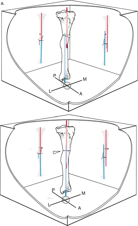 تصحيح تشوهات الانحراف والإزاحة العظمية: دليل شامل للمرضى مع الأستاذ الدكتور محمد هطيف