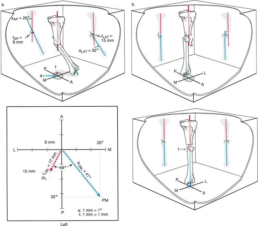 صورة توضيحية لـ تصحيح تشوهات الانحراف والإزاحة العظمية: دليل شامل للمرضى مع الأستاذ الدكتور محمد هطيف