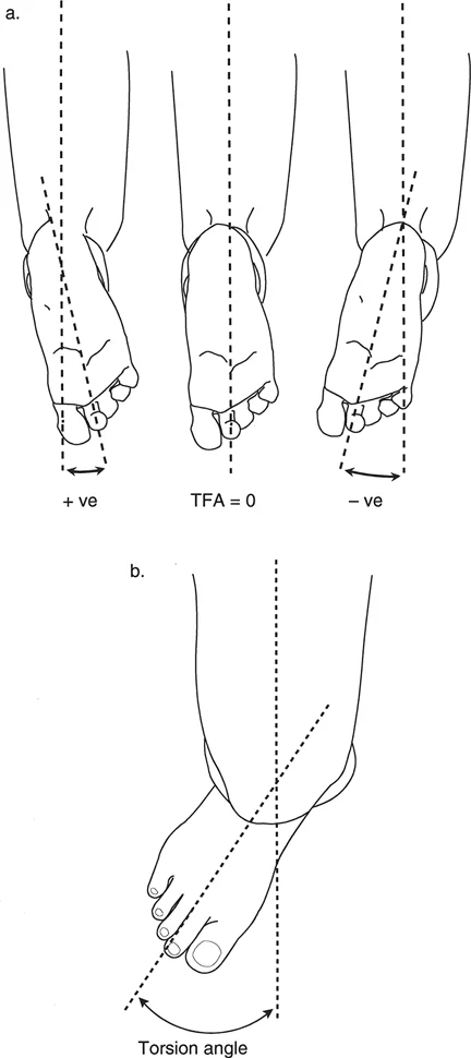 تقييم التواء عظم الساق (وضعية الاستلقاء على البطن والجلوس). (أ) قياس محور الفخذ والقدم (TFA) في وضعية الاستلقاء على البطن. (ب) تقييم وضعية الجلوس بالنظر إلى محور عظم الساق.