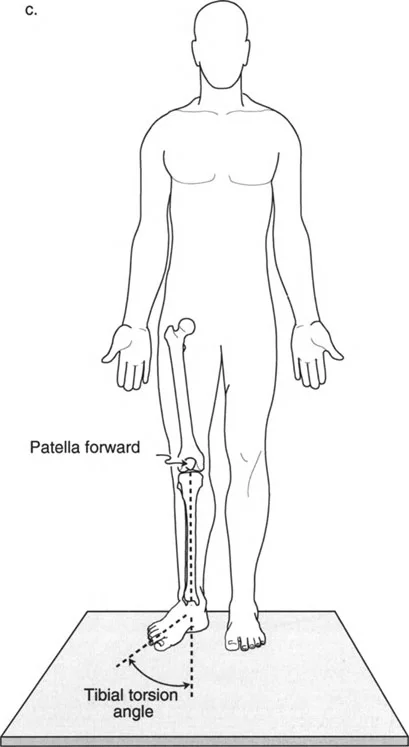 تقييم التواء عظم الساق (وضعية الوقوف). يتم توجيه الرضفة للأمام تمامًا، ويتم قياس زاوية القدم بالنسبة للمستوى السهمي.