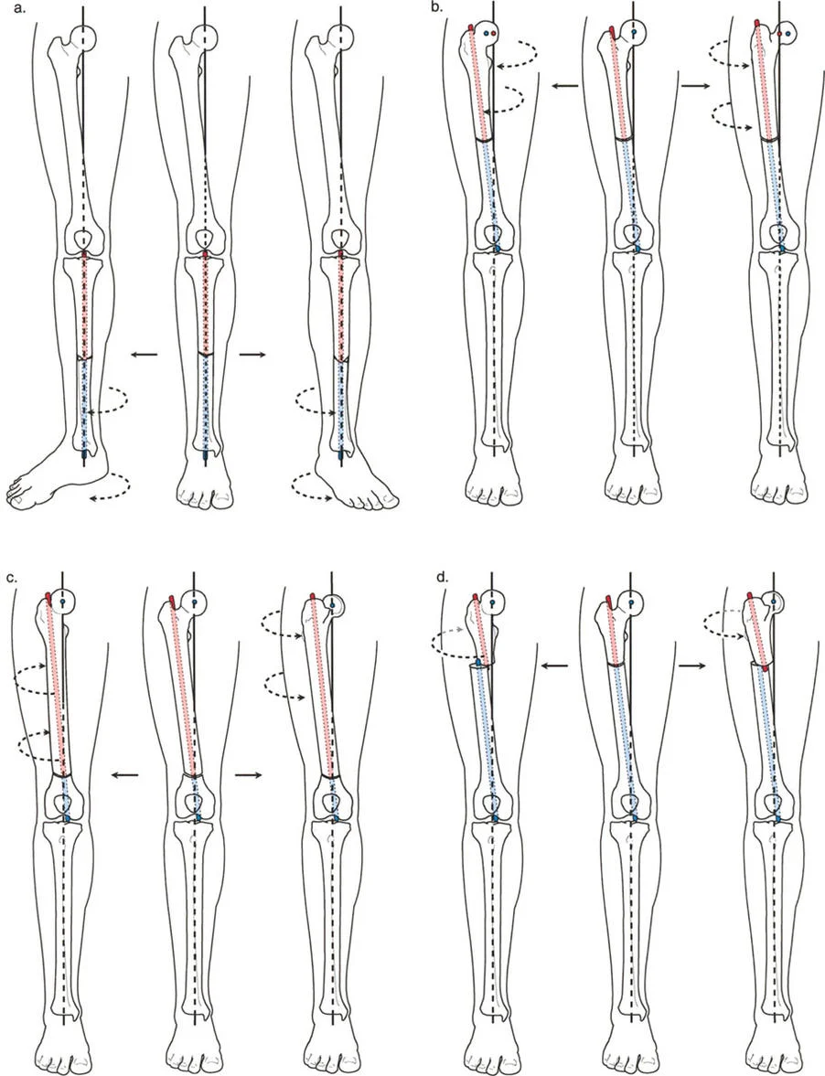 سلوك بيوميكانيكي لعمليات قطع العظم الدورانية. (أ) الساق: الدوران حول المحور التشريحي لا يسبب سوء محاذاة. (ب) الفخذ (المحور التشريحي): الدوران في جسم العظم حول المحور التشريحي يزيح رأس الفخذ مسببًا انحراف المحور الميكانيكي. (ج) الجزء البعيد من الفخذ (المحور الميكانيكي): عملي وآمن، حيث تتقاطع المحاور هنا. (د) الجزء القريب من الفخذ (المحور الميكانيكي): غير عملي بسبب الإزاحة الهائلة لأطراف العظم.