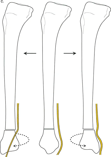 صورة طبية: تشوهات الدوران والانحراف الزاوي في العظام: دليل المريض الشامل من الأستاذ الدكتور محمد هطيف