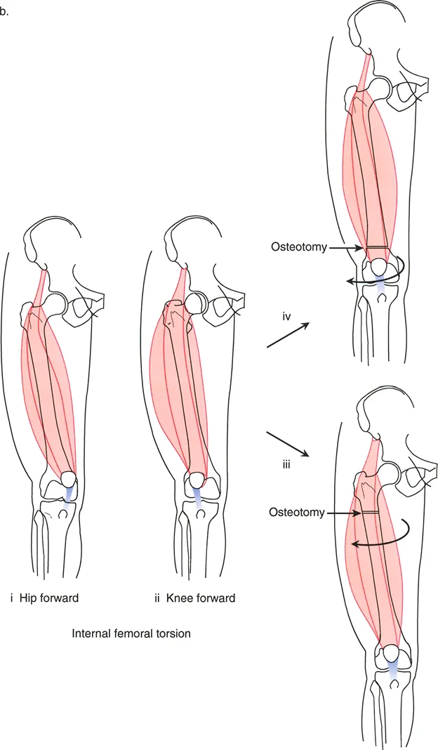 صورة توضيحية لـ تشوهات الدوران والانحراف الزاوي في العظام: دليل المريض الشامل من الأستاذ الدكتور محمد هطيف