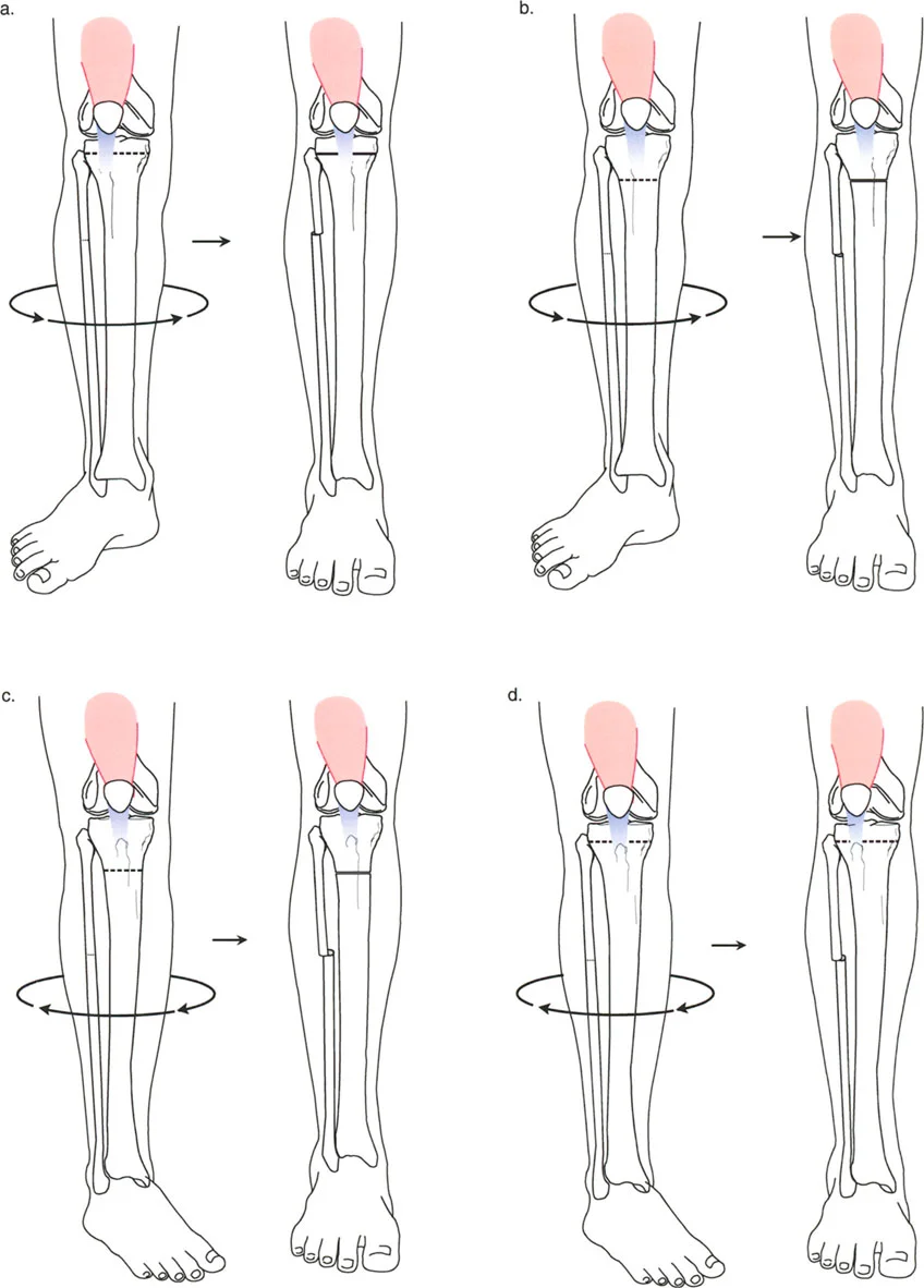 صورة طبية: تشوهات الدوران والانحراف الزاوي في العظام: دليل المريض الشامل من الأستاذ الدكتور محمد هطيف