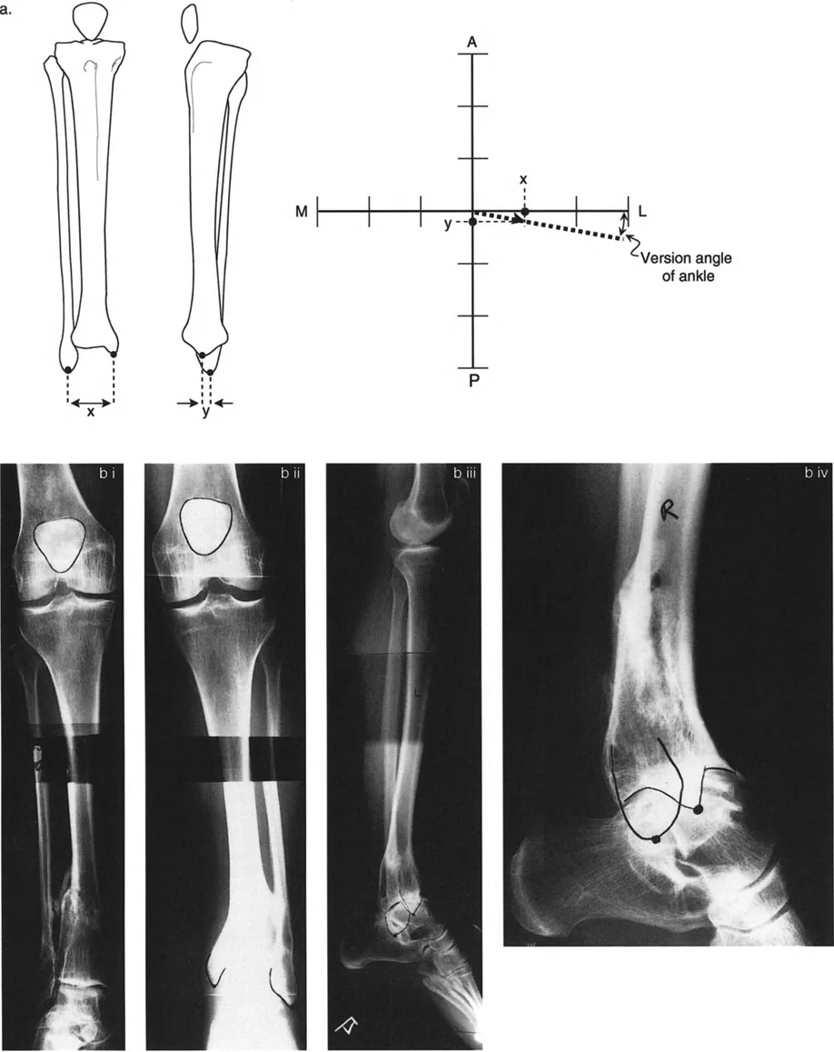 صورة توضيحية لـ تشوهات الدوران والانحراف الزاوي في العظام: دليل المريض الشامل من الأستاذ الدكتور محمد هطيف