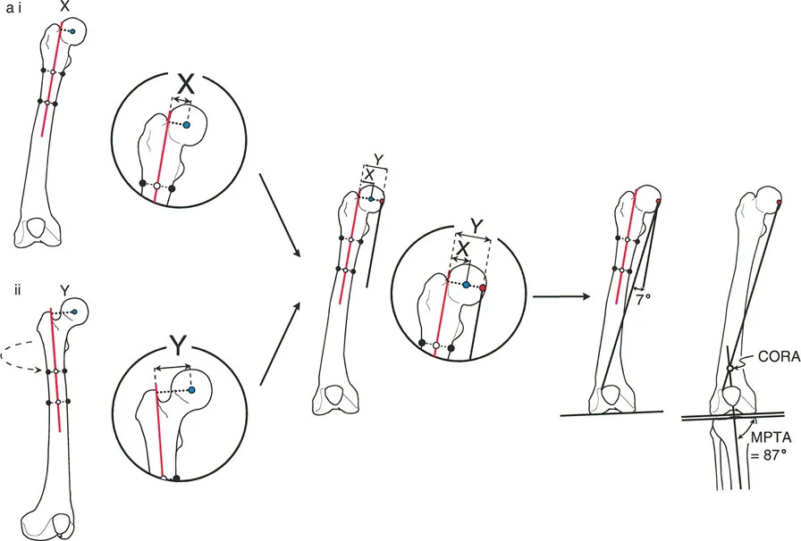 صورة توضيحية لـ تشوهات الدوران والانحراف الزاوي في العظام: دليل المريض الشامل من الأستاذ الدكتور محمد هطيف
