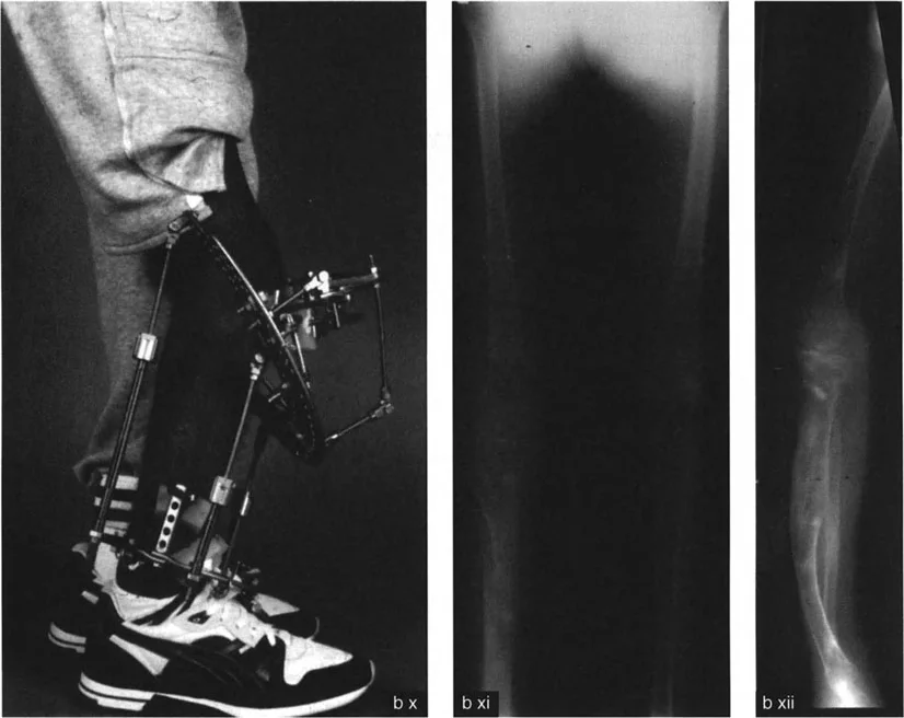 تشوهات الدوران والانحراف الزاوي في العظام: دليل المريض الشامل من الأستاذ الدكتور محمد هطيف