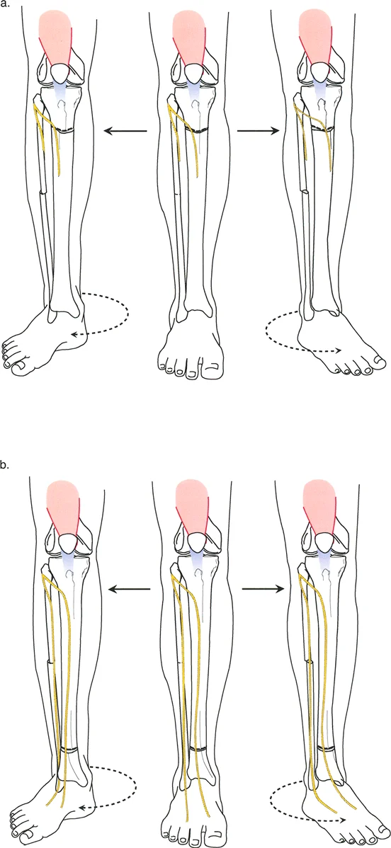 صورة طبية: تشوهات الدوران والانحراف الزاوي في العظام: دليل المريض الشامل من الأستاذ الدكتور محمد هطيف