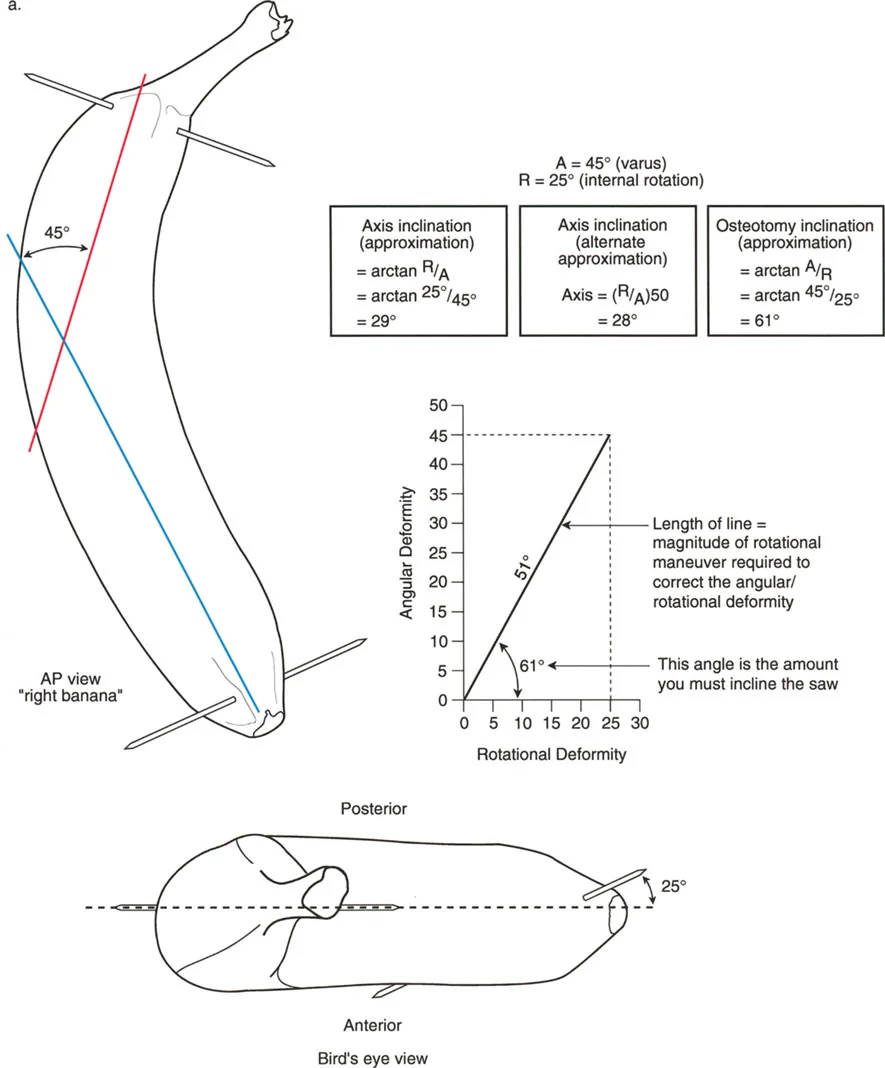 صورة توضيحية لـ تشوهات الانحراف والدوران في العظام: الحل الجراحي المتقدم بقطع مائل واحد لاستعادة وظيفة الأطراف