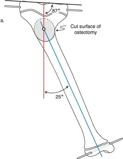 صورة توضيحية لـ تقنية بالي لقطع العظم المائل: الحل الجراحي المتقدم لتشوهات الأطراف المعقدة في صنعاء