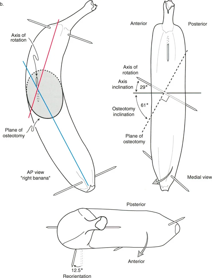 تقنية بالي لقطع العظم المائل: الحل الجراحي المتقدم لتشوهات الأطراف المعقدة في صنعاء