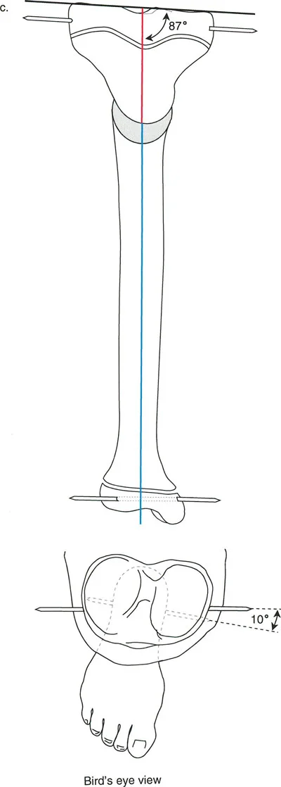 صورة توضيحية لـ تقنية بالي لقطع العظم المائل: الحل الجراحي المتقدم لتشوهات الأطراف المعقدة في صنعاء