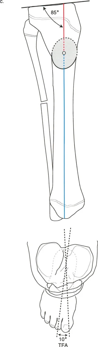 قياس التشوه الدوراني باستخدام المحور الفخذي القدمي (TFA)