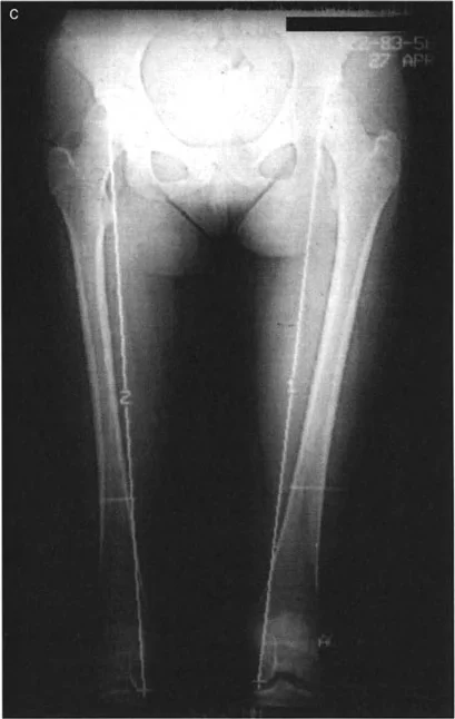 صورة توضيحية لـ تفاوت طول الأطراف: دليلك الشامل لتصحيح فرق طول الساقين مع الأستاذ الدكتور محمد هطيف