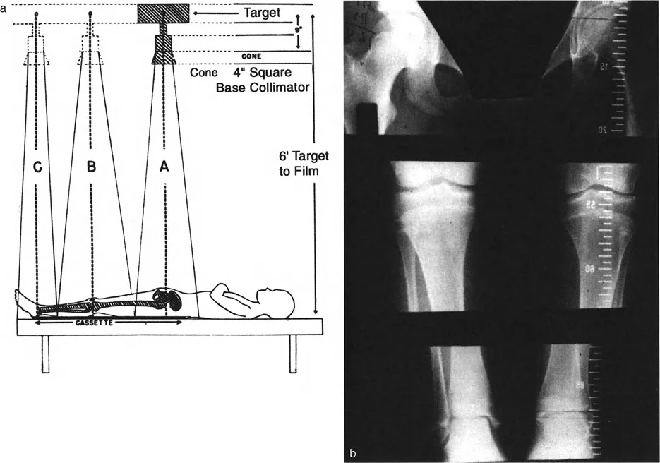 صورة توضيحية لـ تفاوت طول الأطراف: دليلك الشامل لتصحيح فرق طول الساقين مع الأستاذ الدكتور محمد هطيف