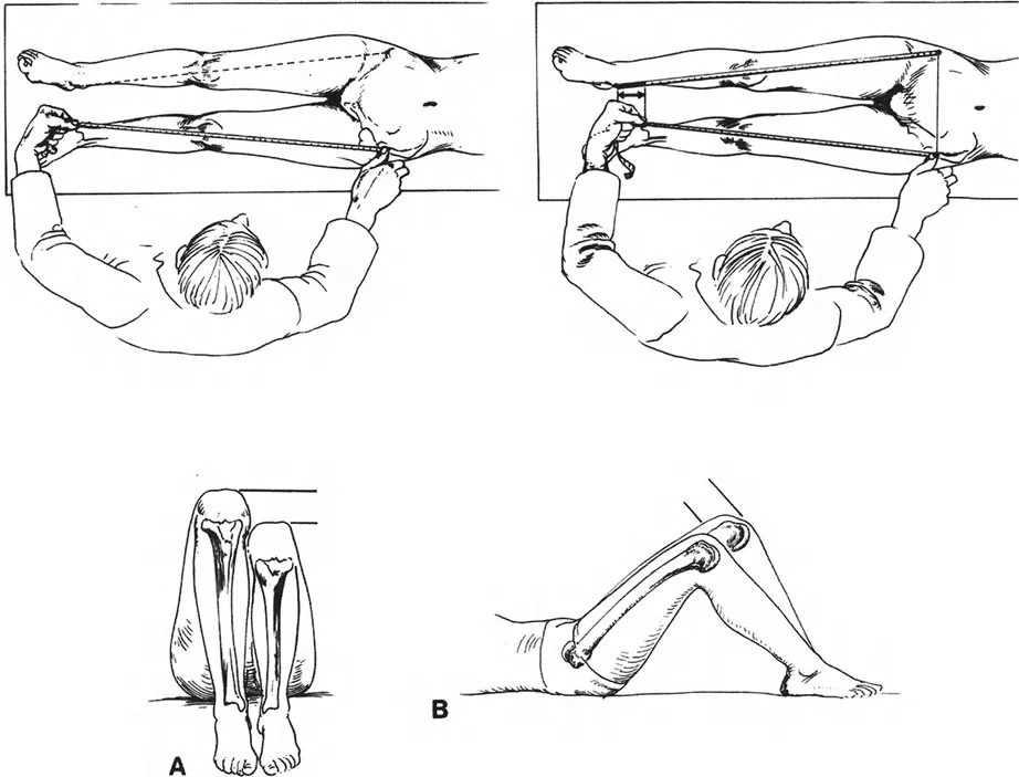 صورة توضيحية لـ تفاوت طول الأطراف: دليلك الشامل لتصحيح فرق طول الساقين مع الأستاذ الدكتور محمد هطيف
