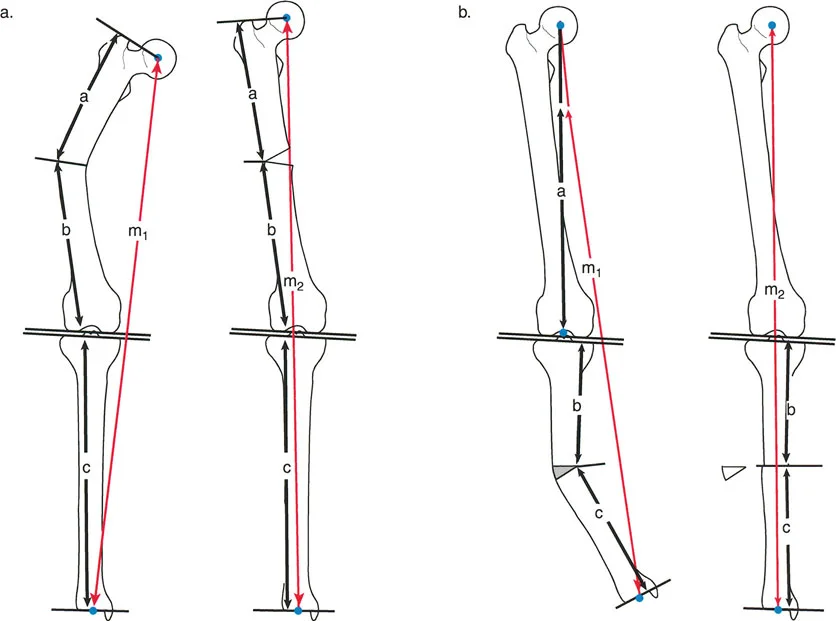 Mastering Length & Deformity Correction: Gradual vs. Acute Osteotomies Masterclass