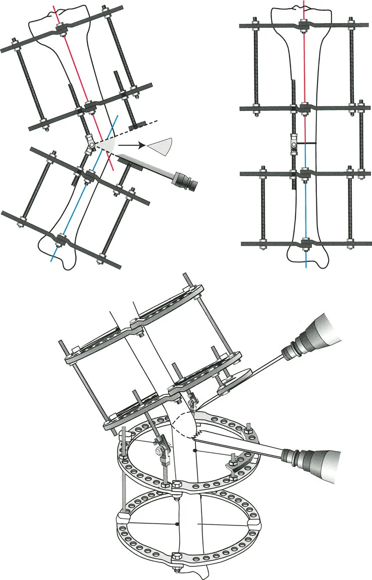 صورة توضيحية لـ تصحيح تشوهات العظام استعادة التوازن والحركة بخبرة الأستاذ الدكتور محمد هطيف في صنعاء