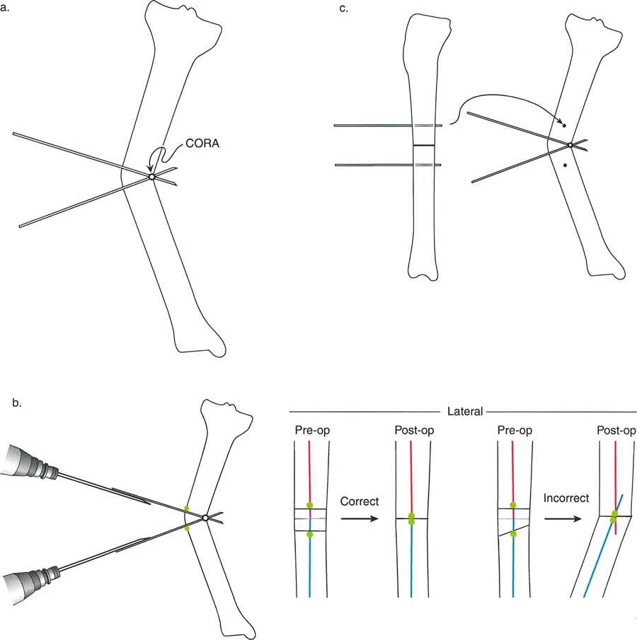 تصحيح تشوهات العظام استعادة التوازن والحركة بخبرة الأستاذ الدكتور محمد هطيف في صنعاء
