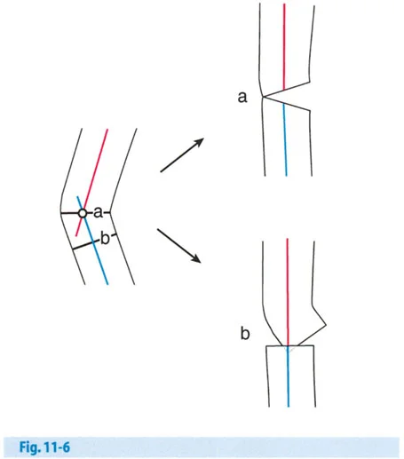 تصحيح تشوهات العظام المتقدمة: دليل شامل لخيارات الجراحة والعلاج من الأستاذ الدكتور محمد هطيف