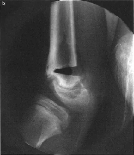 صورة توضح إزالة إسفين عظمي بزاوية 24° مع توجيه القاعدة خلفيًا. الأهم من ذلك، تبقى القشرة الأمامية سليمة لتعمل كمحور تصحيح الزاوية (ACA).