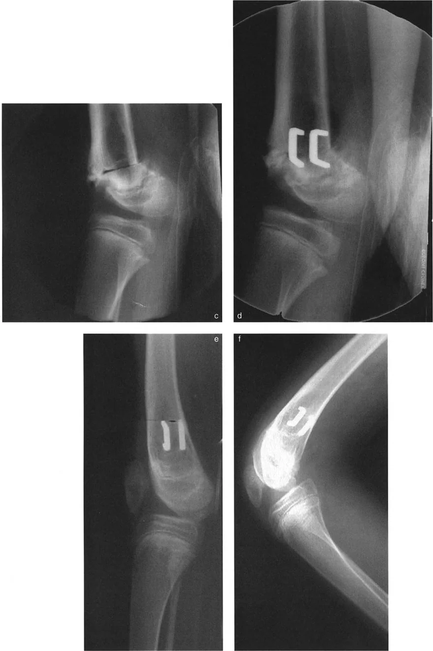 صورة توضيحية لـ تصحيح تشوهات العظام المتقدمة: دليل شامل لخيارات الجراحة والعلاج من الأستاذ الدكتور محمد هطيف