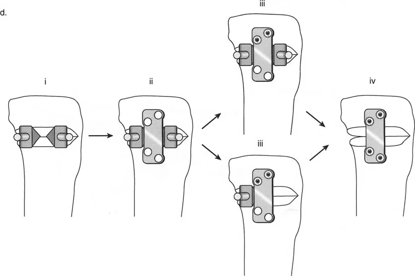 إتقان تصحيح تشوهات العظام: دليلك الشامل لأحدث التقنيات والحلول الجراحية مع الأستاذ الدكتور محمد هطيف في صنعاء