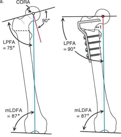 Mastering Deformity Correction: The Ultimate Guide to Hardware and Osteotomy Considerations