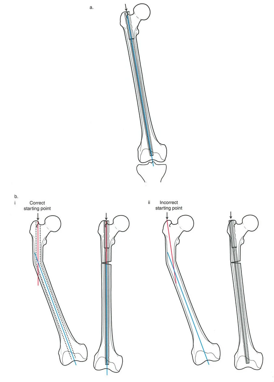 تصحيح تشوهات الأطراف السفلية بالمسمار النخاعي: دليل شامل للمرضى مع الأستاذ الدكتور محمد هطيف
