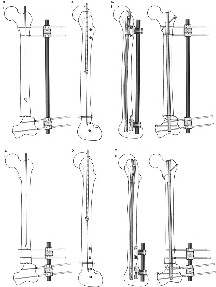 صورة توضيحية لـ تصحيح تشوهات الأطراف السفلية المتقدمة: دليل شامل لتقنيات بالي في اليمن