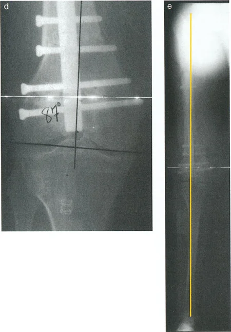 صورة طبية: تصحيح تشوهات الأطراف السفلية المتقدمة: دليل شامل لتقنيات بالي في اليمن