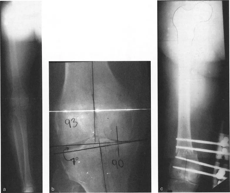 صورة طبية: تصحيح تشوهات الأطراف السفلية المتقدمة: دليل شامل لتقنيات بالي في اليمن